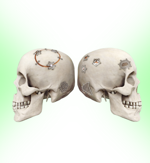 Neuro Plating System
